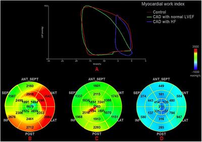 Myocardial Work by Speckle Tracking Echocardiography Accurately Assesses Left <mark class="highlighted">Ventricular Function</mark> of Coronary Artery Disease Patients